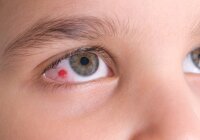 kraujosruva akies hipertenzijoje
