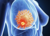 Kviečia suklusti moteris: tai padeda užkirsti kelią krūties vėžiui, o susirgus – padidina galimybę pasveikti