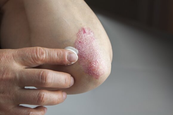 Liga, kuri prasideda nekaltu odos niežėjimu, o baigiasi sąnarių persodinimu: kam susirgti – didžiausia rizika?