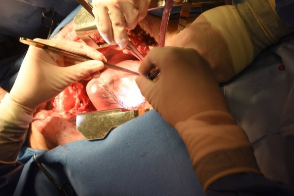 JAV chirurgai sėkmingai persodino genetiškai modifikuotos kiaulės širdį 57 metų vyrui per pirmąją kada nors atliktą tokio pobūdžio operaciją