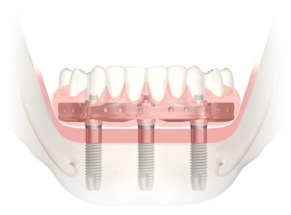 Švediškų implantų gydymo metodika, antkurianti visus apatinio žandikaulio dantis vos ant trijų implantų, per vieną dieną.