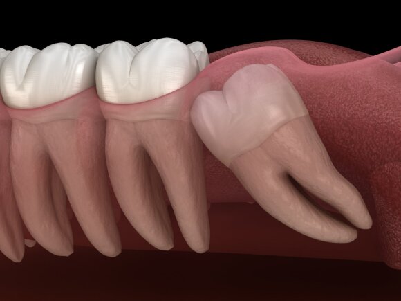 Wisdom teeth