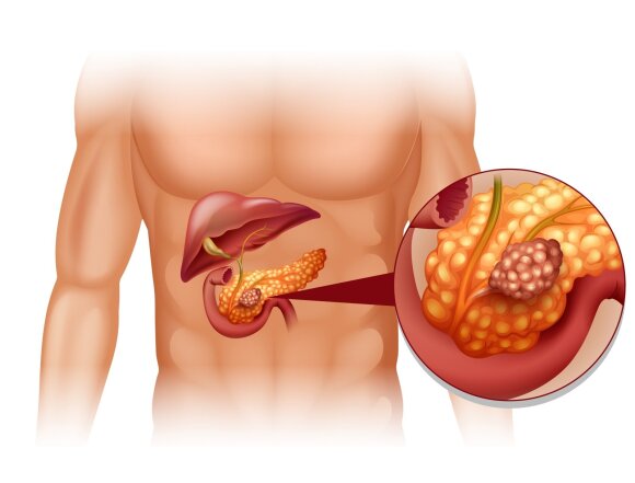 Pancreatic cancer