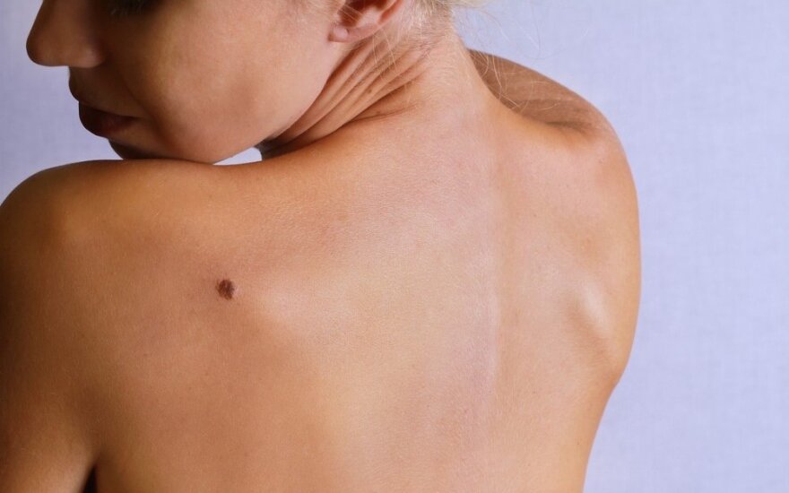 23-ejų metų Žanetai nustatė melanomą: apgamą iš kitų išskyrė du požymiai