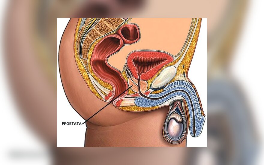 Mokslininkai: kai kurias prostatos vėžio formas sukelia virusas