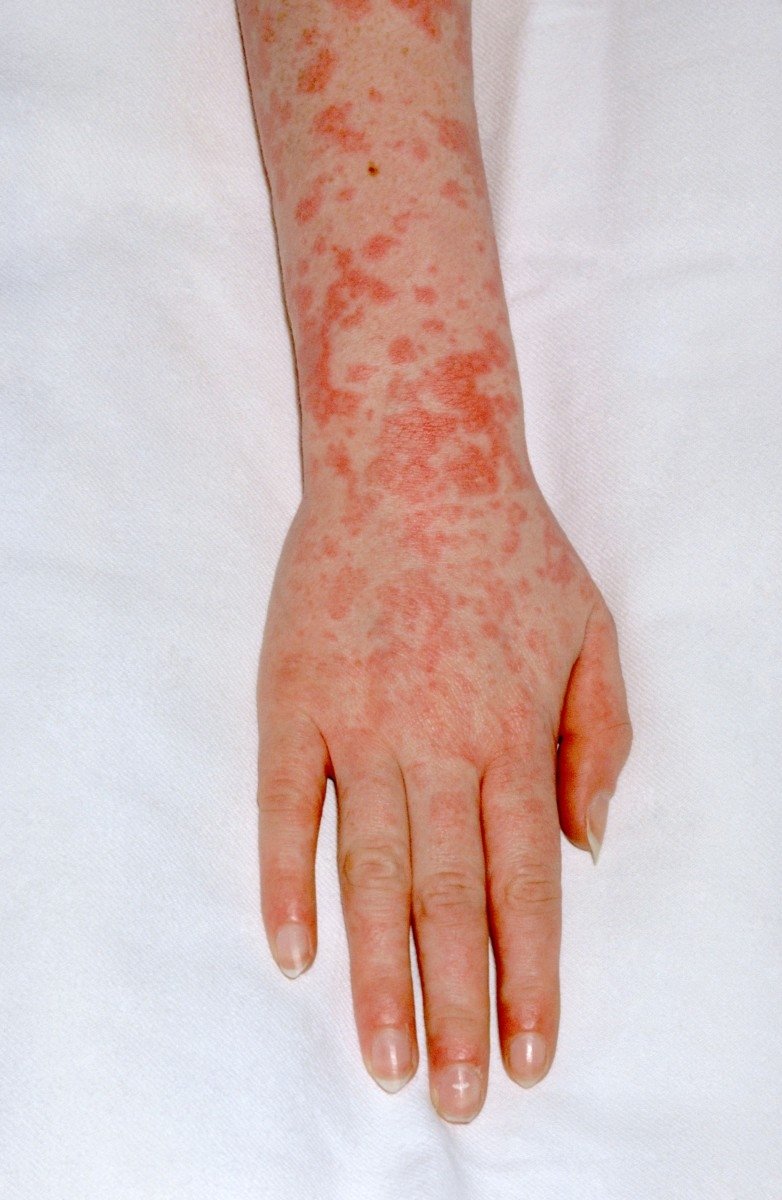 Grybelines odos ligos kaip gydyti